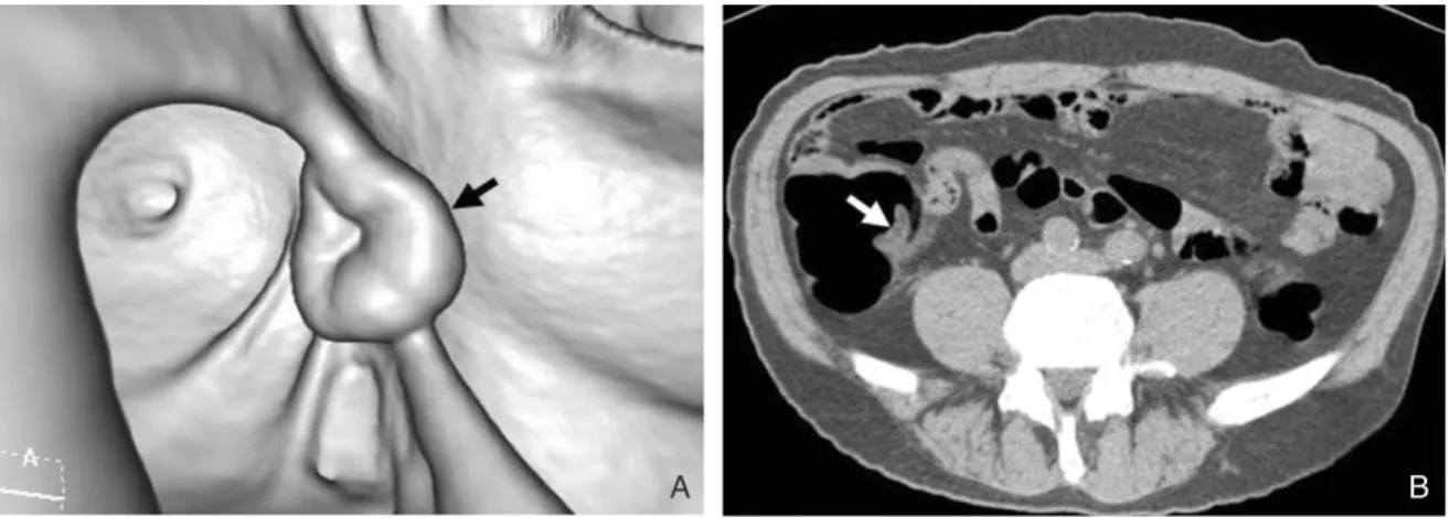 Figure 5. Normal ileocecal valve