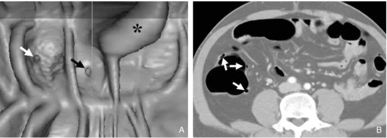 Figure 6. Diverticula in the ascending colon