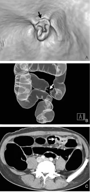 Figure 8. Colon cancer