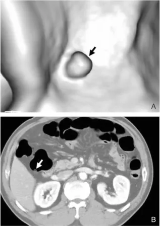 Figure 10. Feces showing position change. Image in a supine position (left) shows a small polypoid lesion (arrow) in the transverse colon