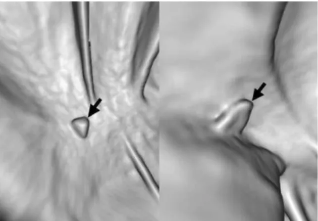 Figure 12. Feces with angular margin. 3D endoluminal images demonstrate angular margins of feces (arrows)