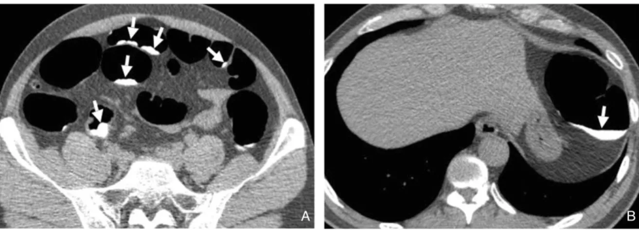 Figure 1. Fecal tagging using 40% high concentration of barium