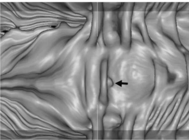 Figure 2. CT colonography using 3D virtual colon dissection technique. 3D virtual colon dissection technique was developed to inspect the inner colonic surface by virtually dissecting the colon along its longitudinal axis.