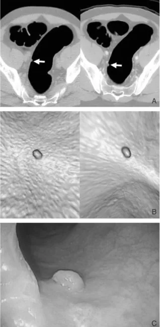 Figure 4. A 1cm pedunculated polyp