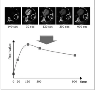 Figure 8. Virtual bronchography using three dimensional volume rendering technique. Tubular structures with high (virtual) enhancement in right upper lobe and left lower lobe (arrows) are tubular  bronchiec-tasis