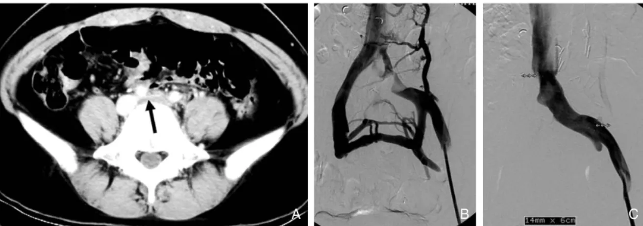 Figure 3. A 44-year-old woman with iliac compression syndrome 