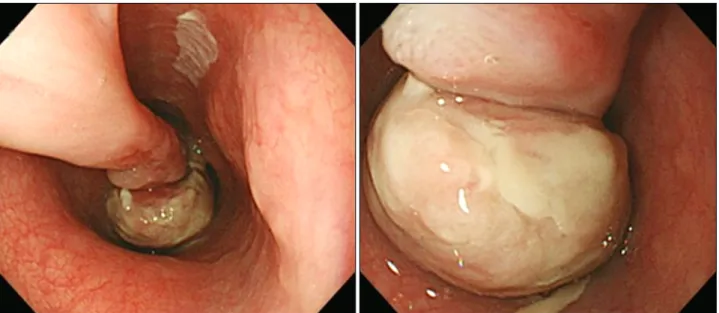 Fig. 1.  Endoscopic examination reveals a huge pedunculated esophageal polyp. The polyp stalk originates at 25 cm from the upper incisors  and the polyp head extends down to 33 cm.