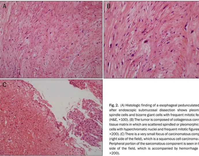 Fig. 2.  (A) Histologic finding of a esophageal pedunculated polyp  after endoscopic submucosal dissection shows pleomorphic  spindle cells and bizarre giant cells with frequent mitotic features  (H&amp;E, ×100)