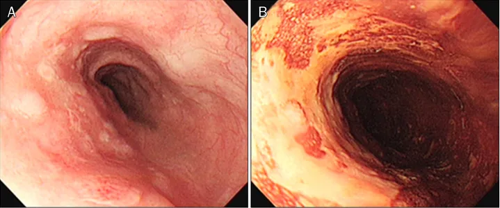 Fig. 4.  Twenty-one months later, endoscopic examination demonstrated poorly-demarcated flat, faint discolored lesions at 30-34 cm from the  upper incisors (A), which are unstained by Lugol solution (B).