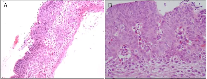 Fig. 5.  A forcep biopsy specimen from flat discolored lesions in the esophagus shows well-differentiated squamous cell carcinoma (H&amp;E; A, 