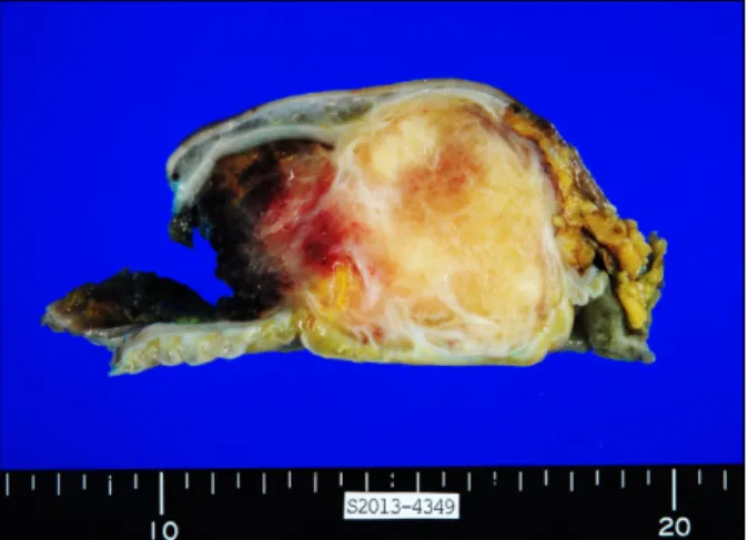 Fig. 2. Gross pathologic image shows ovoid well demarcated lesion and bisecting surface demonstrates a mixture of yellow colored,  mucoid and fibrous tissue.