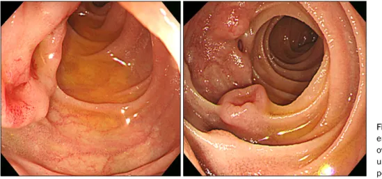 Fig. 1. Initial esophagogastroduod- esophagogastroduod-enoscopy. Mass-like lesions with  overlying normal mucosa and central  ulceration are seen in the 2nd and 3rd portion of the duodenum.