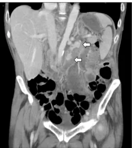 Fig. 2. Abdominal computed tomography. Two well-enhancing lesions (arrows) are observed in the third portion of the duodenum.