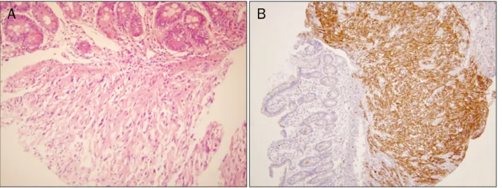 Fig. 4. Histologic examination of the biopsy specimen. (A) Spindle shaped cells arranged in fascicular pattern are seen (H&amp;E, ×100)