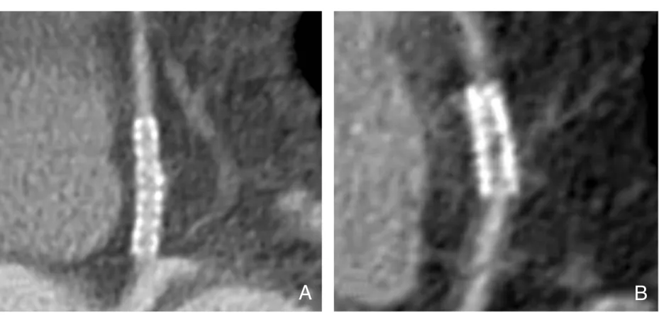 Figure 2. Visualization of patent stent lumen and in-stent restenosis with coronary MDCT angio- angio-graphy