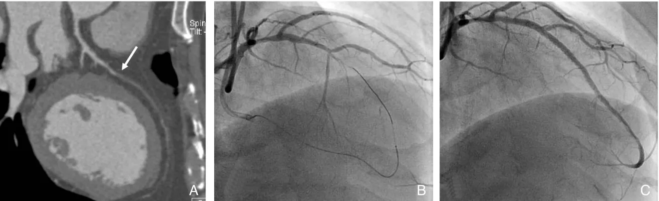 Figure 3. Coronary intervention in chronic total occlusion. A total occlusion is noted from the mid to distal left anterior descending artery (A)