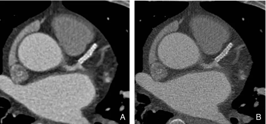 Figure 5. CT image reconstruction affecting evaluation of coronary stents. The image that is reconstructed with a sharpkernel for evaluation of stents (B) is superior in evaluation of in-stent lumen to the image that is reconstructed with a soft-kernel for