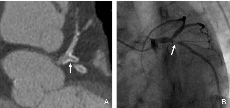 Figure 6. In -stent restenosis and peri-stent small aneurysms of drug-eluting stent. The 64- 64-MDCT image shows in -stent restenosis (arrow) at the distal part with eccentric neointimal proliferation as a low density (A)