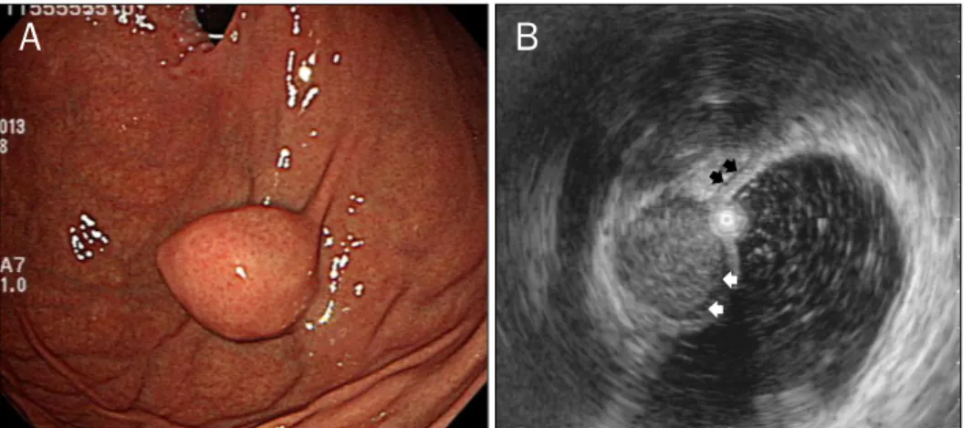 Table 3. Endoscopic Ultrasonography Features of the Patients with GSs and GISTs of the Stomach
