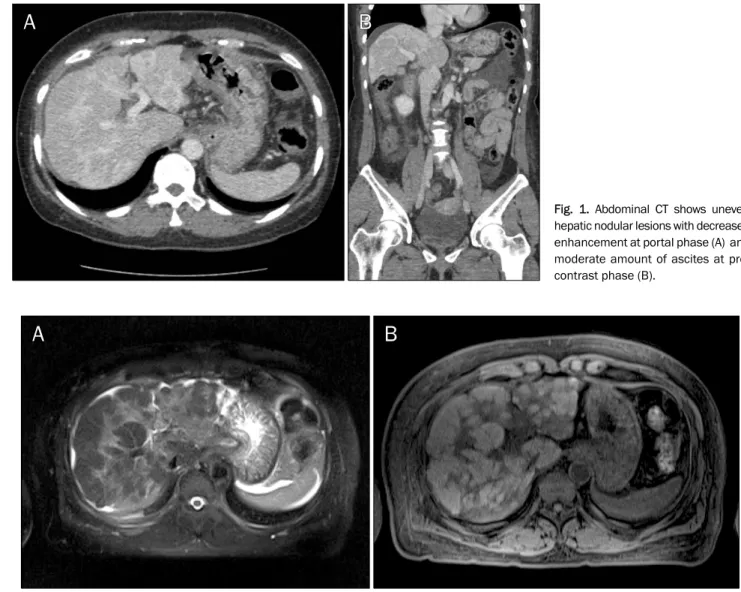 Fig. 2. Initial liver MRI shows large T2 low (A) and T1 high (B) nodular lesions in the liver.