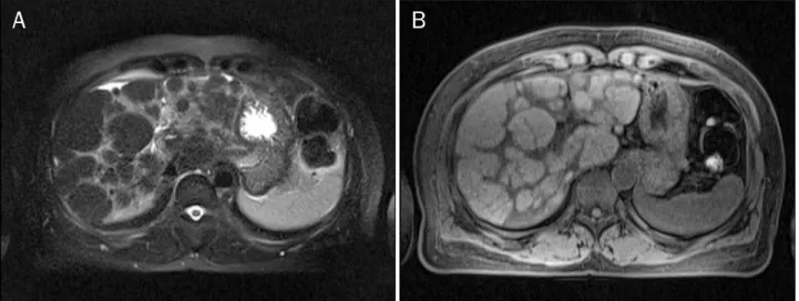 Fig. 4. Follow-up liver MRI shows progression of nodular regenerative hyperplasia in the liver