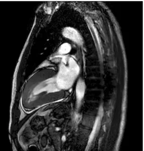 Fig. 2. Cardiac MRI. Diffuse left ventricular wall thickening is noted on vertical long axis veiw.