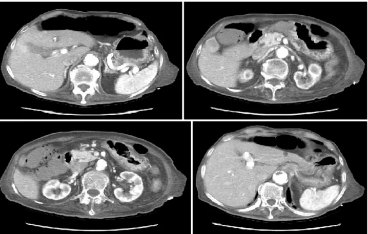Fig. 5. Resolution of previously observed esophageal, gastric and portal venous air indicates improvement of emphysematous gastritis