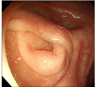 Fig. 4. Colonoscopy finding shows a normal appearing appendiceal  orifice except for mild mucosal inflammation.