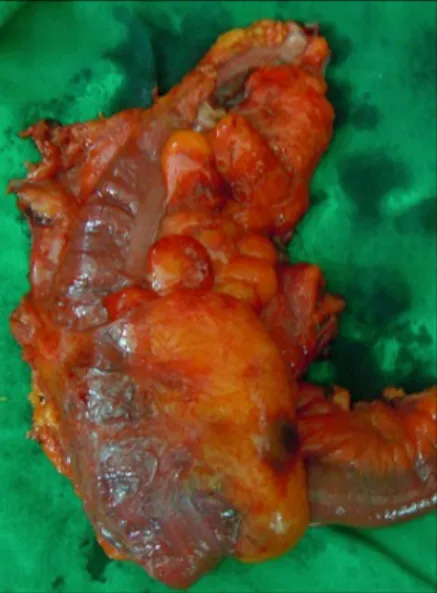 Fig. 6. Microcopic finding of lymph node (H&amp;E,×200).
