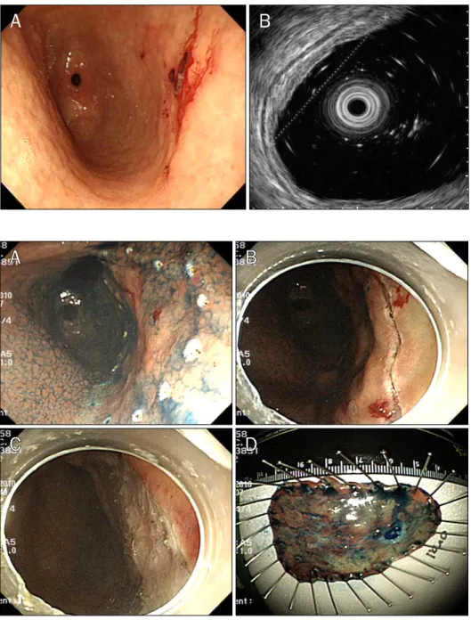 Fig. 1. (A) Initial gastroscopy. An  irregularly elevated lesion, which bled easily when touched, is noted at the  posterior wall of the antrum