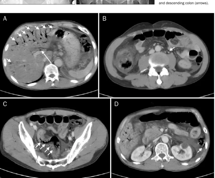 Fig. 2. Abdominal computed tomography scan. (A) Numerous air densities are noted in the distal portal vein branches of the liver (short arrows), and gas is also seen in the extrahepatic portal vein (long arrow)