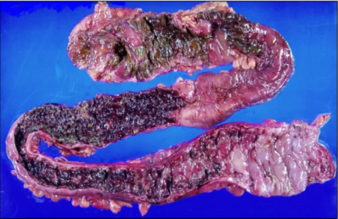 Fig. 3. Gross finding. Extensive necrosis and hemorrhagic infarction  are seen on the entire colon.