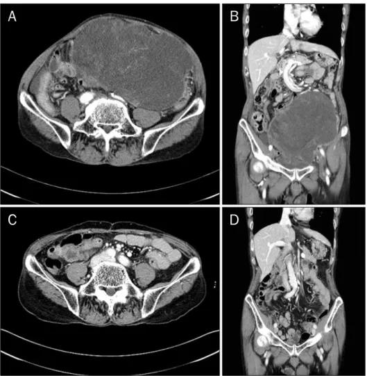 Fig. 1. (A, B) Pre-operative enhanced  computed tomography findings. The  peritoneal cavity is almost occupied  by heterogeneously enhancing huge  mass measuring about 25×10 cm  with multiple area of necrosis and  inseparable from the sigmoid colon