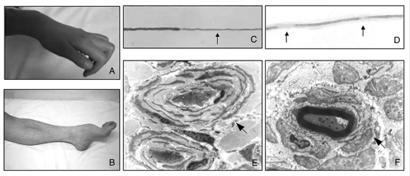 Figure 2. Clinical and pathological phenotypes of Charcot -Marie-Tooth disease. Hand muscle atrophy (A) and leg muscle atrophy with high -arched foot deformity (B)
