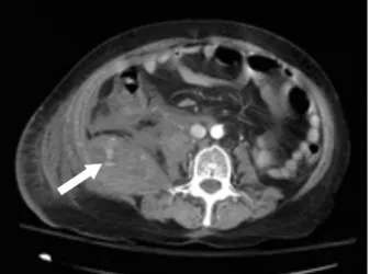 Fig. 2. CT angiography. Axial CT shows nodular and linear high  attenuation that is iso-attenuating relative to the inferior vena cava.