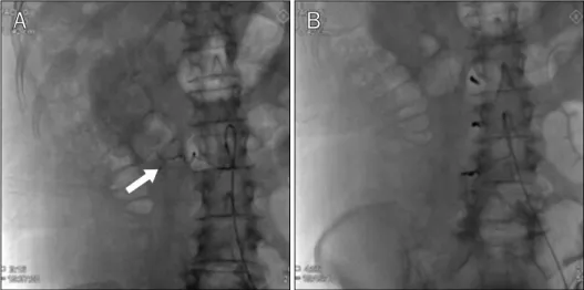 Fig. 3. Conventional angiography. (A)  Conventional angiogram shows active extravasation of contrast material  (arrow) from right lumbar arteries (L2)