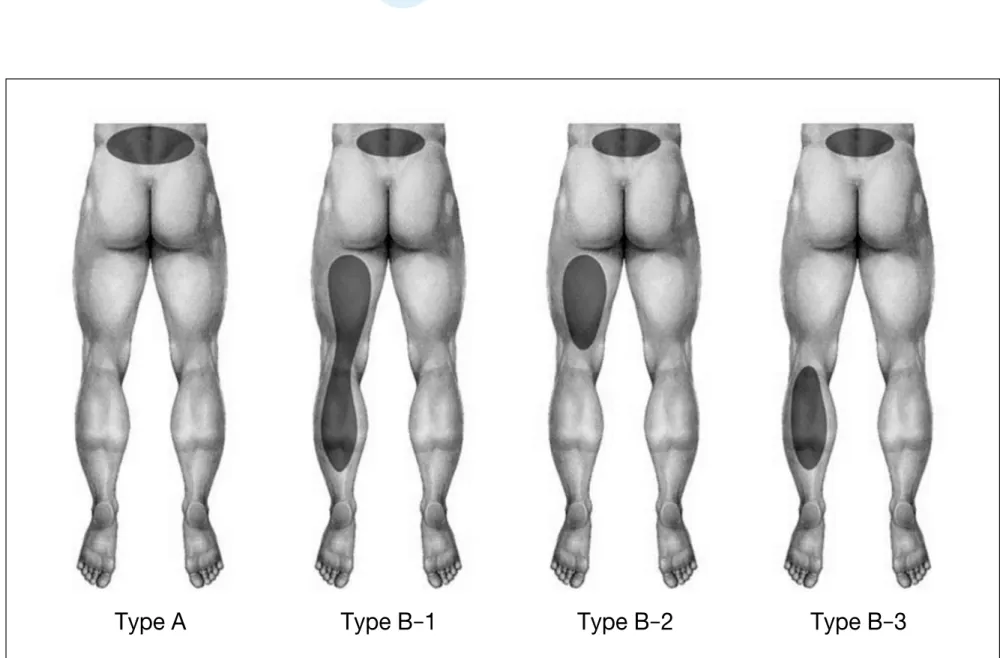 Figure 3.  Pain distribution patterns in lumbar zygapophyseal joint dysfunction. Type E (undetermined type) is not depicted here.