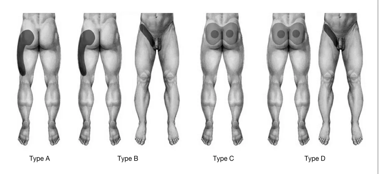 Figure 4.  Pain distribution patterns in sacroiliac joint dysfunction. Type E (undetermined type) is not depicted here.