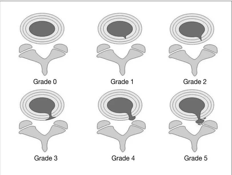 Figure 6.  Modified Dallas discogram classification. Note that disk degeneration is confined inside the disk in Grade 1, 2, and 3