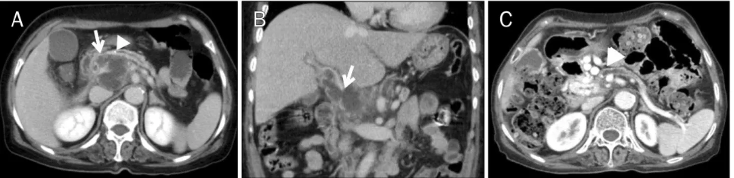 Fig. 3. Image studies of Case 3. (A, B) Axial and coronal views of the abdominal CT scan