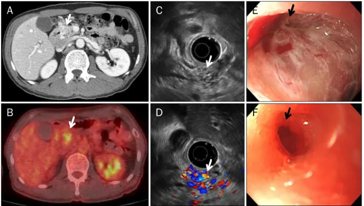 Fig. 4. Image studies of Case 4. (A) Axial view of the abdominal CT scan. A 1.7-cm multifocal ill-defined low-density lesion with multiple enhancing tubular structures at the head of the pancreas was observed (arrow)