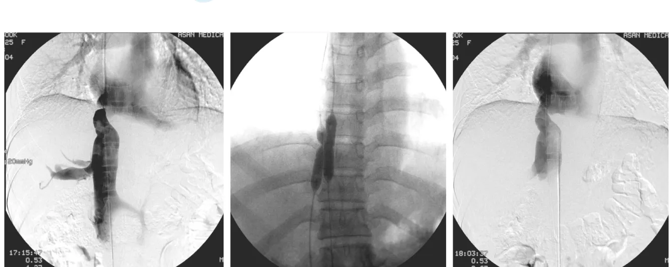 Figure 3.  Angioplasty for Budd-chiari syndrome. Membranous obstruction of suprahepatic inferior vena cava was treated with double balloon angioplasty resulted in hemodynamic improvement