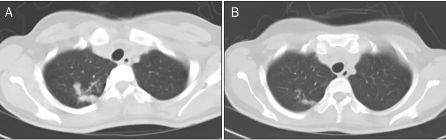 Fig. 1. Chest CT findings. (A) Chest CT shows ill-defined patchy consolidation and small nodules in the right upper lobe