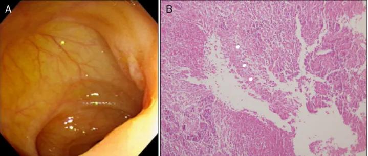 Fig. 3. Colonoscopic and microscopic findings. (A) Exudate covered shallow ulcer is shown on terminal ileum