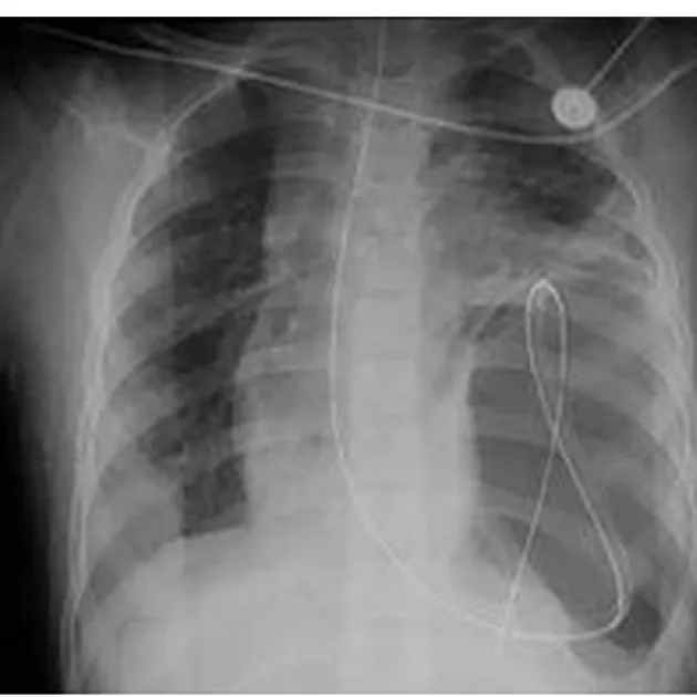 Figure 2.   The above chest radiograph shows nasogastric tube in the right thoracic cavity.