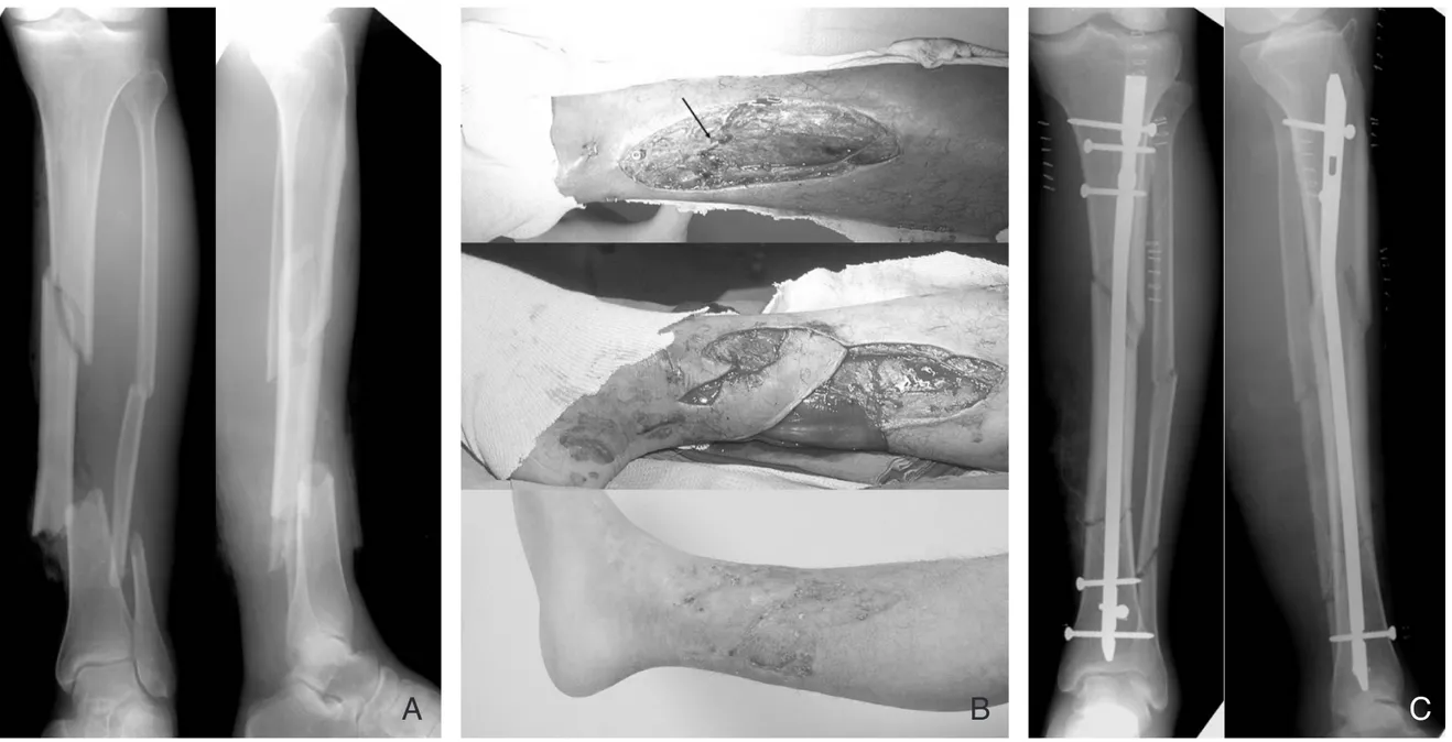 Figure 1.   Type Ⅲ B open tibial and fibular fracture. 