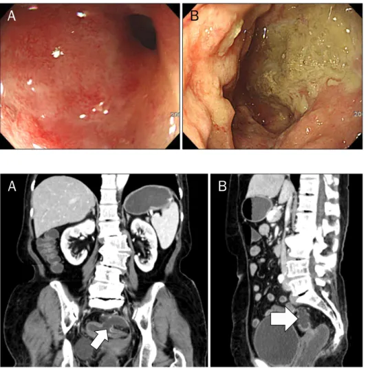 Fig. 1. Endoscopic findings. (A) Diffuse edematous mucosa with capillary  dilatation and luminal narrowing is  seen on rectosigmoid juction