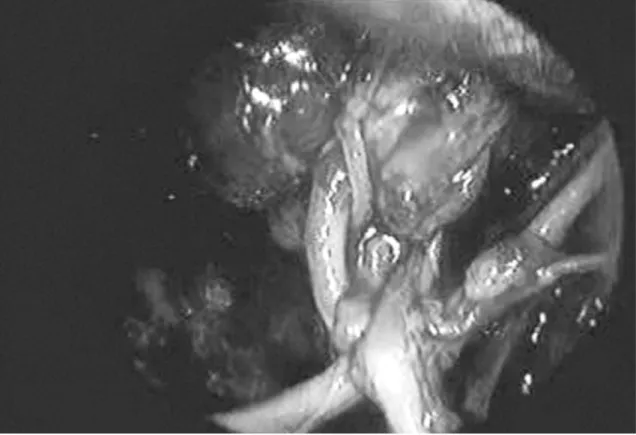 Figure 1.  Endoscopic view of recurrent laryngeal nerve and infe - -rior thyroid artery