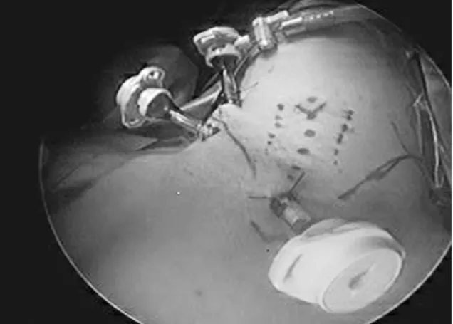 Figure 2.  Port insertion in the cervical endoscopic thyroidectomy.