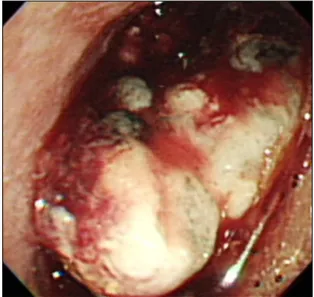 Fig. 2. Esophagogastroscopy shows an ulcerative mass with  bleeding and necrosis on the distal esophagus.